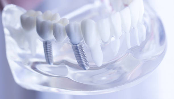 Dental Implants in Malad, Mumbai