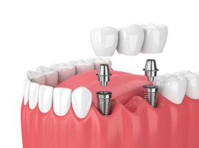 Picture4 - Impladent Pain-Free Dentistry