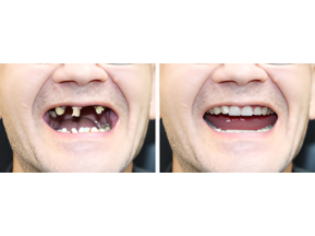 Full-Mouth Rehabilitation - Impladent Full-Mouth Rehabilitation