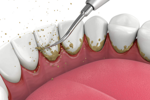 Periodontal Treatment