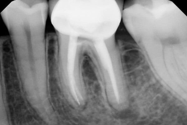 Endodontic Treatment