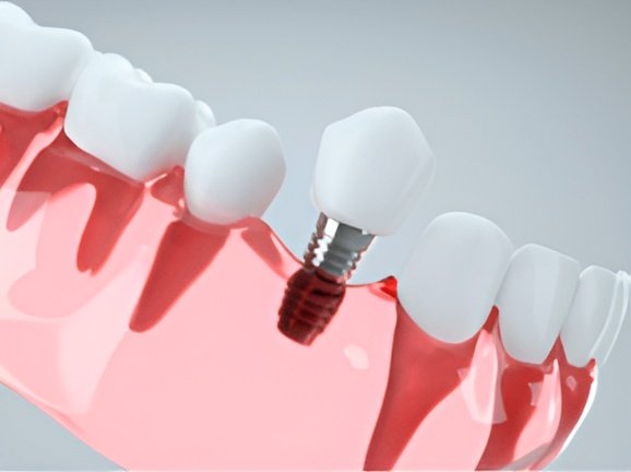 Single-Tooth Implants - Impladent Single-Tooth Implants