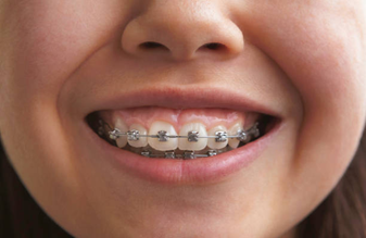Traditional Metal Braces - Impladent Traditional Metal Braces