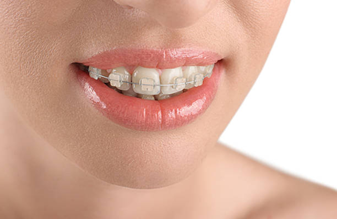 Ceramic Braces - Impladent Ceramic Braces