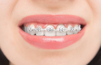 Self-Ligating Braces - Impladent Self-Ligating Braces