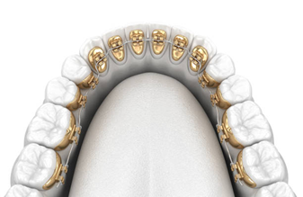 Lingual Braces - Impladent Lingual Braces