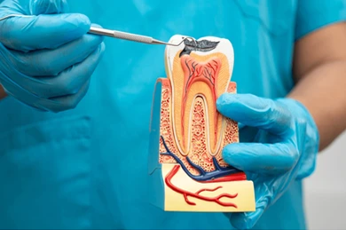 Root Canal Treatment in Malad, Mumbai