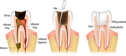 Our Root Canal Treatment Process