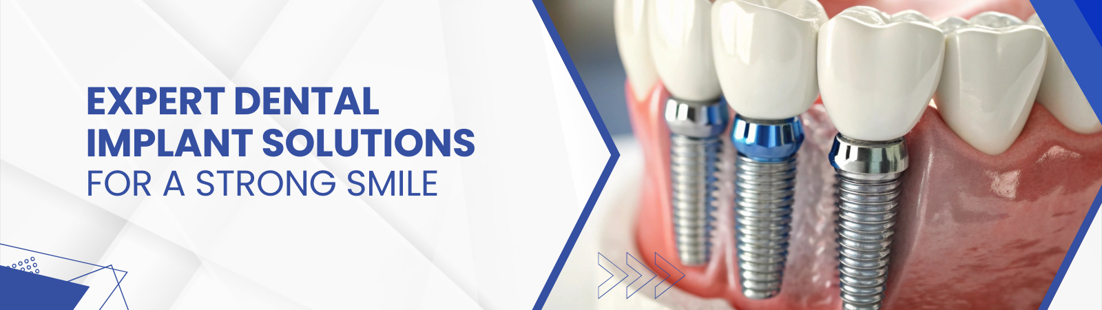 dental-implant-banner