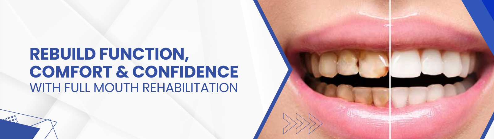 full-mouth-rehabilitation-banner