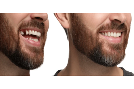 dental-implants - Impladent dental-implants