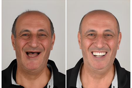 Prosthodontics - Impladent Prosthodontics