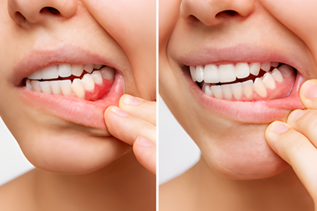 Periodontal Care - Impladent Periodontal Care