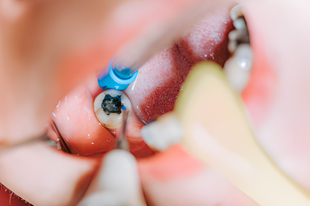 Endodontic Care - Impladent Endodontic Care