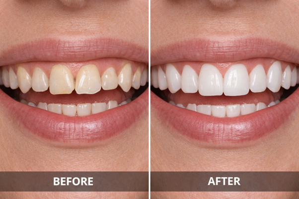 veneers-before-and-after