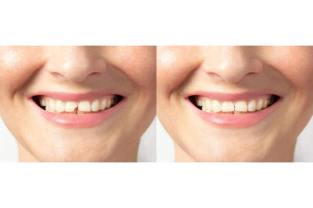 dental-bonding - Impladent dental-bonding