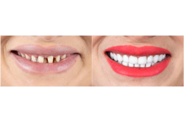 Full-Mouth Rehabilitation - Impladent Full-Mouth Rehabilitation