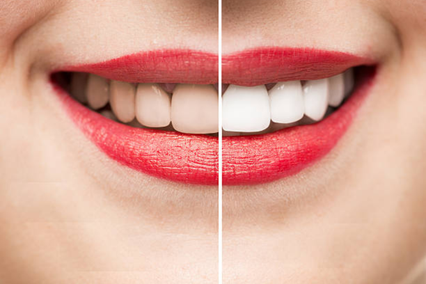 Teeth-Whitening - Impladent Teeth-Whitening