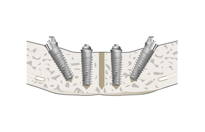 How All-on-4 Implants Work