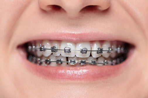 Close-up of a smile with metal braces on both upper and lower teeth.