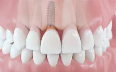 Single Tooth Implant vs Dental Bridge?