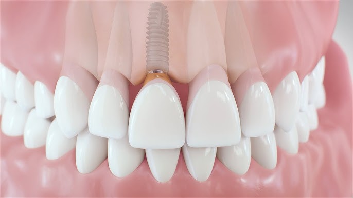 Single Tooth Implant vs Dental Bridge?
