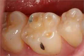 Close-up of molars showing a dark cavity on the chewing surface and a small metal filling in one tooth.