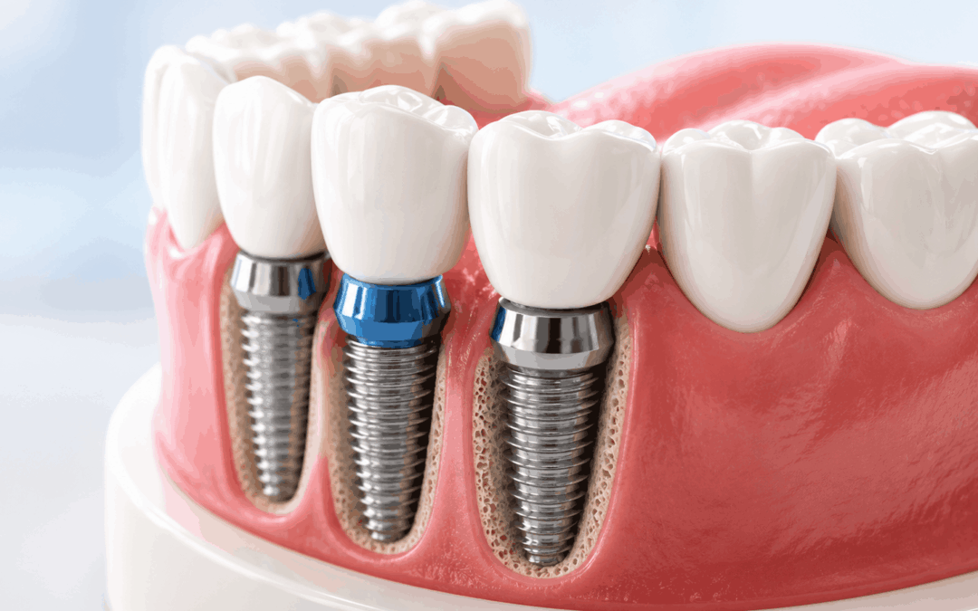 Full Mouth Rehabilitation 8 Signs You May Need It