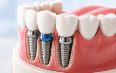 Full Mouth Rehabilitation: 8 Signs You May Need It?