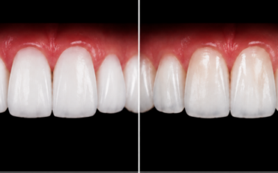 Zirconia vs Porcelain Veneers: Key Facts You Should Know