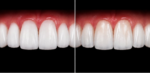 Split-screen close-up of upper front teeth and gums showing before and after whitening on each side of the image.