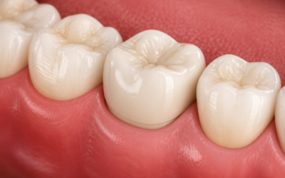 How long do crowns last on molars