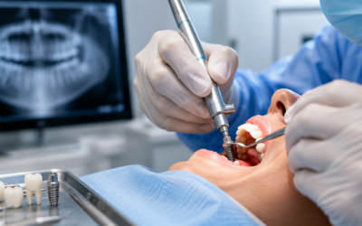 How Much Do Dental Implants Cost in Mumbai?