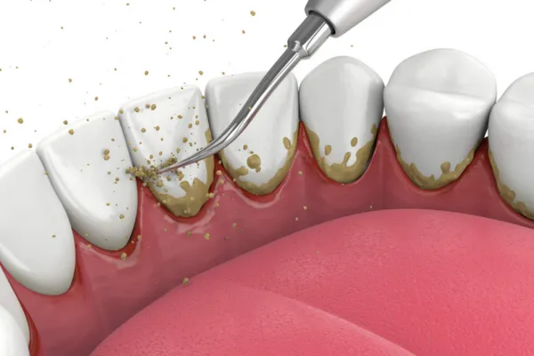 Periodontal Treatment