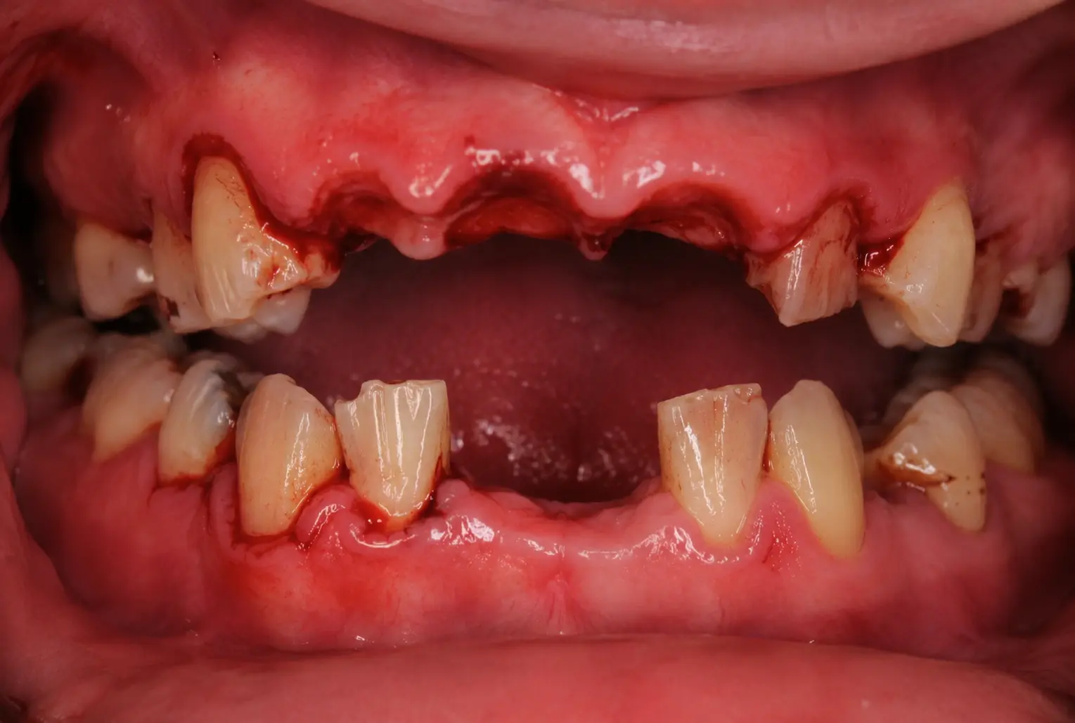 Clinical view of severe dental decay with an edentulous upper jaw, missing teeth, and inflamed, bleeding gums; lower teeth are damaged and misaligned.