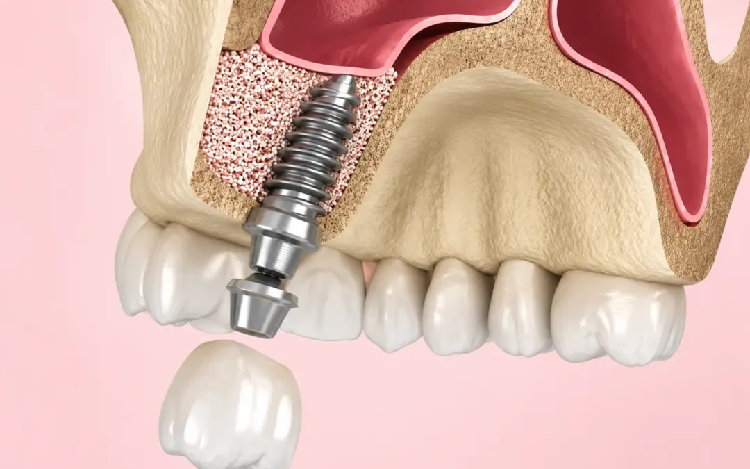 Sinus Lift Before Implants Do You Really Need One